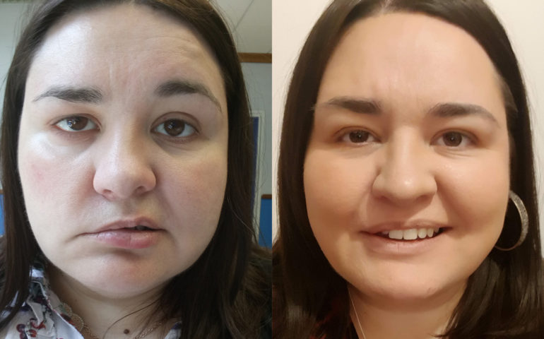 I Woke Up With A Broken Face Living With Bell S Palsy By Amy Green United Response